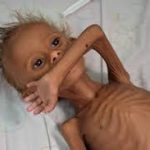 enfants victime de la guerre au yemen