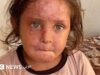 غزة : آلاف الإصابات بأمراض جلدية معدية تراكم الضغط على نظام صحي منهك